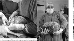 肚痛沒月經！少女子宮驚見15公斤巨瘤(圖/鏡報)