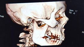 （圖／翻攝自漣水日報）中國,漣水,筷子,眼窩