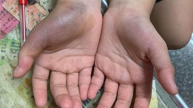 錯10題數學　女童被師用水管抽到…