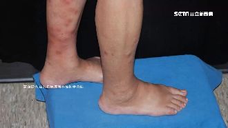 小腿長紅疹…竟罹「癌王」死亡率9成
