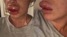 女愛美微整豐唇，一覺醒來腫成4倍大香腸嘴。（圖／翻攝Daily Mail）