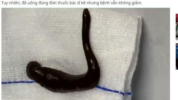 他狂咳血一個月！氣管竟藏巨大活水蛭