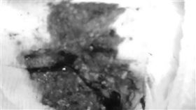 男嬰拉「果醬血便」掛急診　醫一查「腸套疊」險腸壞死（圖／來講兒科急診的543-吳昌騰醫師授權）