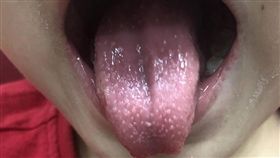 草莓舌,川崎症,兒科醫師,徐嘉賢,黑眼圈奶爸Dr. 徐嘉賢醫師,草莓舌頭,猩紅熱