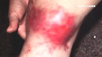 燙傷誤信偏方　婦傷口惡化險遭截肢