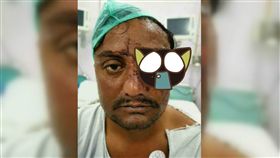 牛,牛角,攻擊,視力,眼球,印度,手術,眼窩,重建,掉出 圖／翻攝自推特　