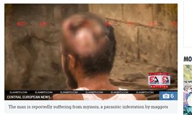 （圖／翻攝自太陽報）哥倫比亞,寄生蟲,喪屍,蠅蛆病,頭殼