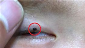 2歲男童出遊…回家眼皮長「黑色凸痣」險死（圖／翻攝自中國新聞網）