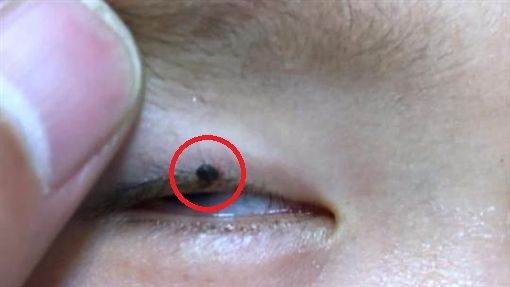 眼皮長「黑色凸痣」　2歲男童險喪命