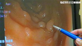 台中慈濟醫院,大腸直腸科,林北江,便秘,血便,痣瘡,大腸鏡,瘜肉,家族性大腸瘜肉症