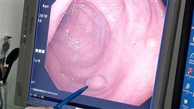 癌症,大腸癌,息肉,大腸息肉,癌變,衛福部彰化醫院,楊智超,大腸鏡

圖／翻攝自衛福部彰化醫院臉書