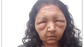  大媽染髮劑「奮力抹整頭」　3小時內腫成鐘樓怪人…眼睛擠到消失（圖／翻攝自每日郵報）