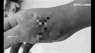 刀傷縫完「血肉模糊」　院方出面解釋