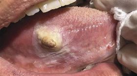 口腔癌　（圖／翻攝自微博）