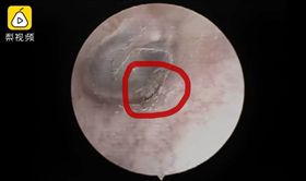 蜘蛛在男子耳裡織網。(圖/翻攝自梨視頻)