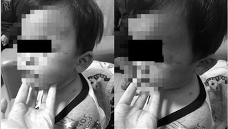 又驚爆虐童案！爸毒打幼兒到鼻青臉腫