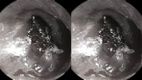 男童一直聽到嗡嗡聲 醫生檢查嚇傻：蜱蟲嵌進耳膜裡（圖／《新英格蘭醫學雜誌》）