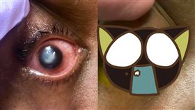 隱形眼鏡,睡覺,角膜,潰爛,隱眼,美國,侵蝕,細菌,　圖／翻攝自臉書　https://parg.co/s1Y