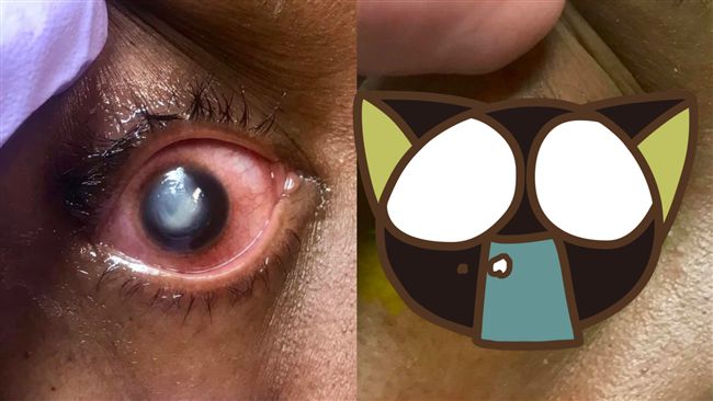 戴「隱眼」睡覺下場超驚人！眼流出…