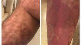 過敏一定治得好？黃鼎殷醫師：排黏液、促微循環就有解！
過敏有救？足蒸腿上竟出現紅紋地圖？