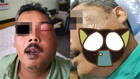 馬來西亞,牙痛,煞車油,機車,偏方,膿包,蜂窩性組織炎　圖／翻攝自臉書