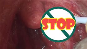 口腔,扁桃腺結石（圖／翻攝自Tonsil Stone Man YouTube）