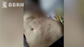 少女抽脂失敗肚皮成橘皮。(圖/翻攝自看看新聞)