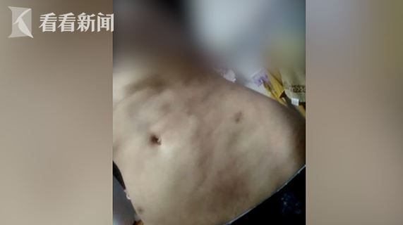 抽脂失敗肚皮變橘皮！她崩潰得憂鬱症