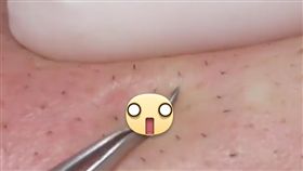 粉刺,美容師,擠粉刺。翻攝自爆廢公社