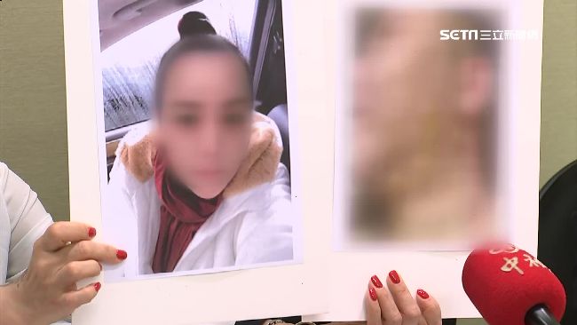 電波拉皮害滿臉水泡　美魔女爆氣提告
