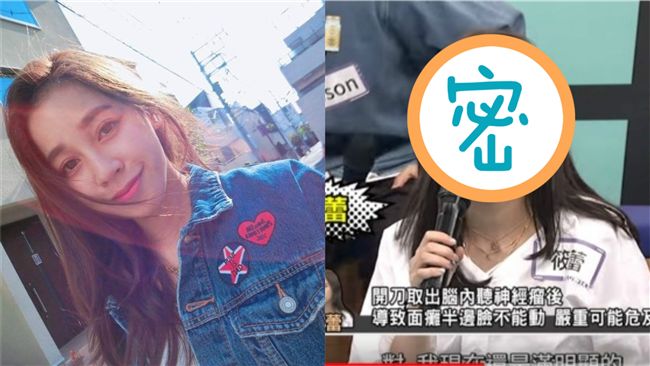 女星長腦瘤動刀！術後面癱臉斜超驚悚