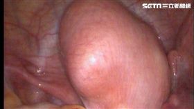 亞洲大學附屬醫院,婦產部,高惠芬,不孕,月經,經痛,子宮肌瘤壓,輸卵管