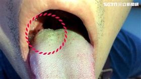 彰化博元婦產科,​蔡鋒博,菜花,嘴巴長菜花
圖／蔡鋒博醫師提供