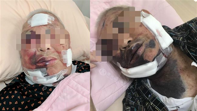 翁遭兒毆斷肋骨！「筍湯孽子」找到了