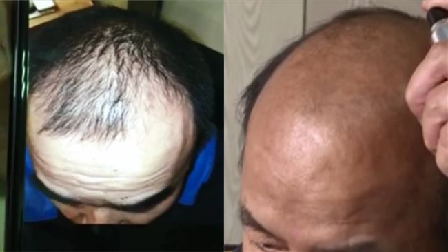 用生髮水治禿頭…結果倖存頭髮也掉光