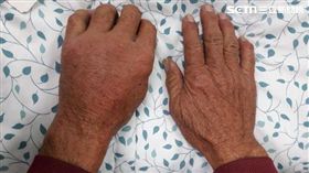 光田綜合醫院,感染科,楊清鎮,海洋分枝桿菌,海岸