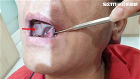 嘴破,破嘴,童綜合醫院,口腔顎面外科,蕭應良,癌病變,惡性腫瘤
圖／童綜合醫院