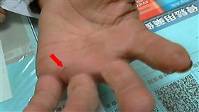 手掌刺傷久不癒　海洋分枝桿菌作祟一名63歲黃姓男子在海邊工作時，手掌不慎被刺傷，赴診所且服用抗生素後仍無改善、手掌持續腫脹，到醫院檢查後才發現是感染海洋分枝桿菌。（光田醫院提供）中央社記者蘇木春傳真　108年5月14日