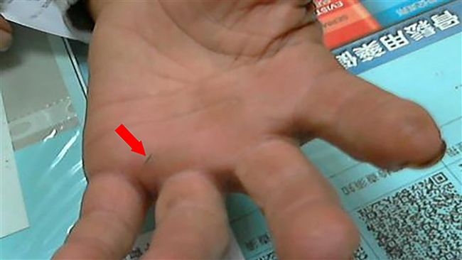 被竹片刺傷感染　男手掌腫成「麵龜」