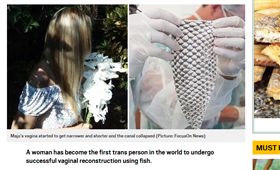 （圖／翻攝自Metro）巴西,變性人,陰道重建,吳郭魚皮