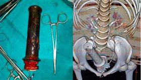 印度，婦人，子宮，單車，手把，丈夫。翻攝自metro news