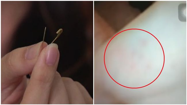女童遭師「別針戳手」　手掌布滿傷痕