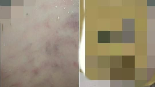 新莊幼兒園驚爆不當體罰！女童全身傷