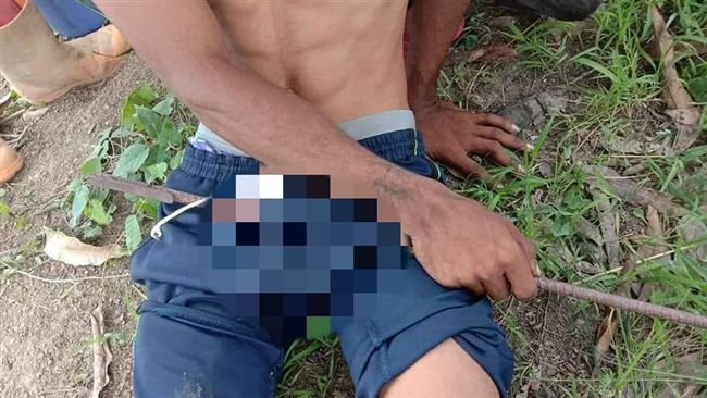 GG遭鋼筋刺穿…猛男痛哭當場被鋸掉