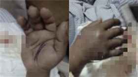 海洋創傷弧菌。（圖／翻攝自爆料公社）