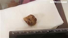 亞洲大學附屬醫院,耳鼻喉部,邱建仁,扁桃腺,結石