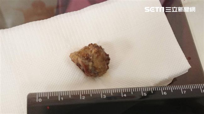 男嘴飄惡臭　隕石級扁桃腺結石險要命