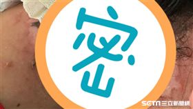 彰化56歲賴姓婦女肩頸痛敷了「黑面馬」葉子草藥，脖子痛到像被火燒黑又腫、腹部還長出水泡。（圖／彰化醫院提供）