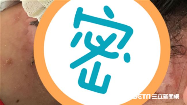 頸痠敷「這」　她脖像「火燒」黑炸痛