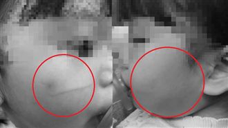 又傳托嬰涉虐　2歲童有巴掌印＋刮傷